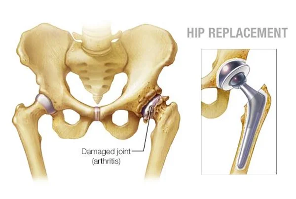 Total Hip Replacement (THR)