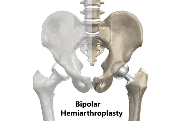 Bipolar Hemiarthroplasty