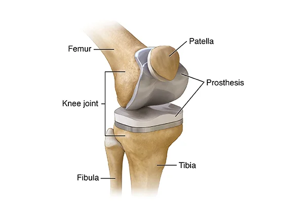 Total Knee Replacement