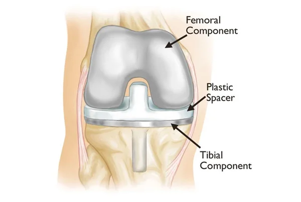 Revision Total Knee Replacement