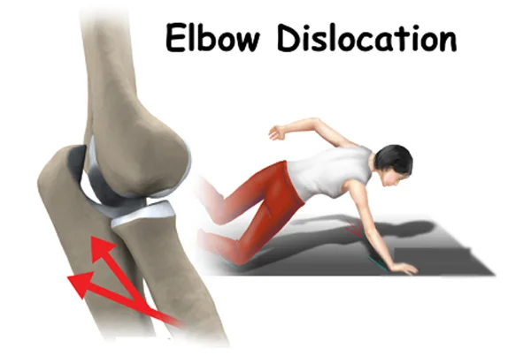 Elbow Dislocation
