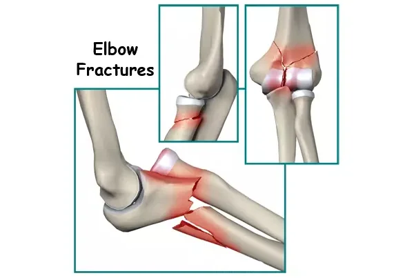 Elbow Fracture