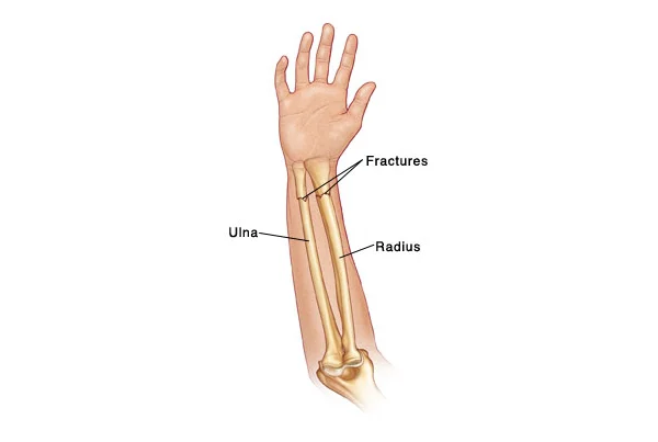 Forearm Fracture
