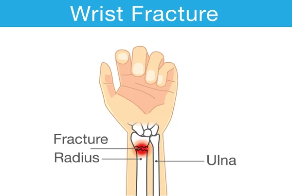 Wrist Fracture