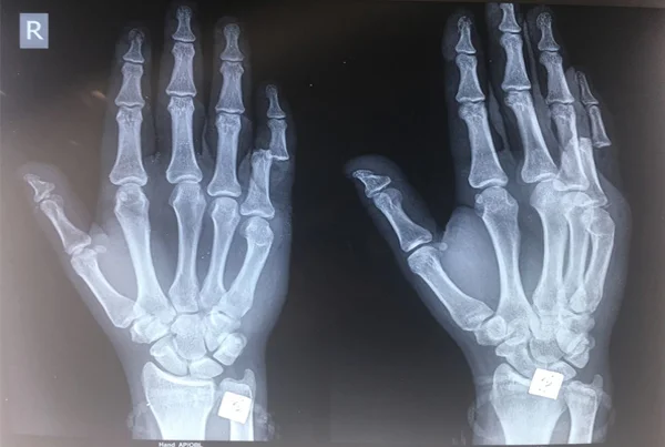 Hand and Finger Fracture