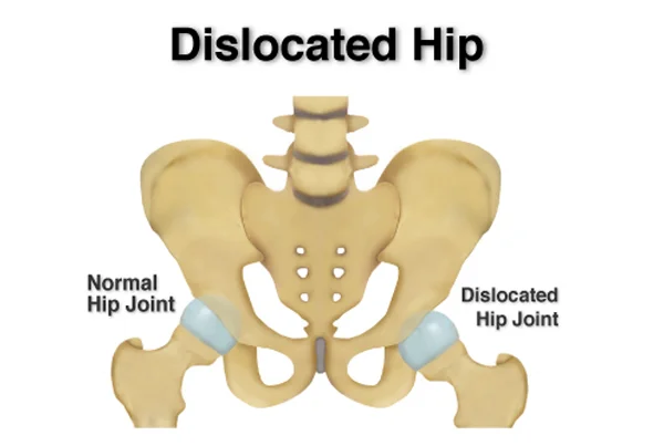 Hip Dislocation