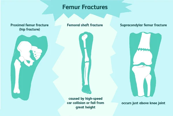 Femur
