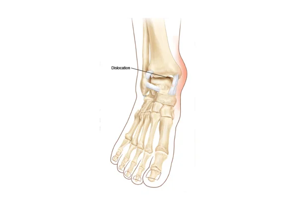 Ankle Dislocation