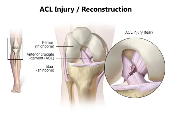ACL Injury / ACL Reconstruction