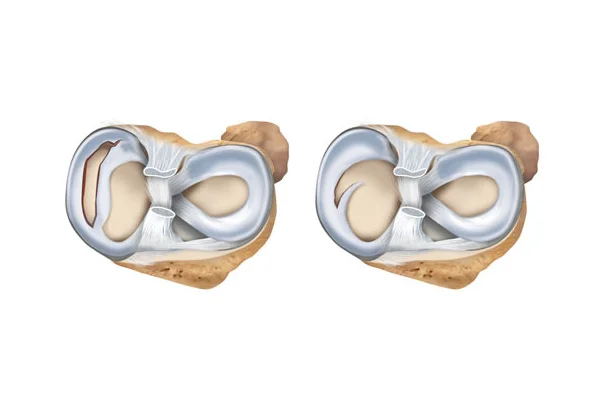 Meniscus Repair
