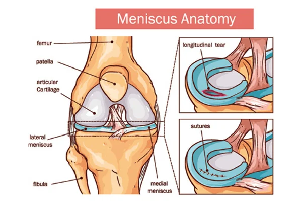 Meniscectomy