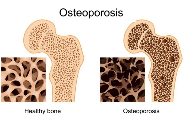 Osteoporosis