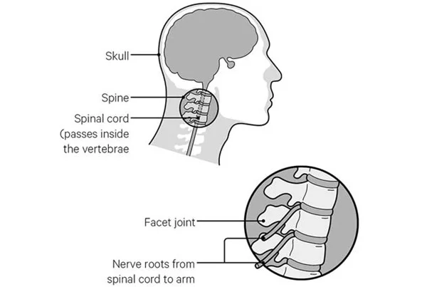 Neck Pain