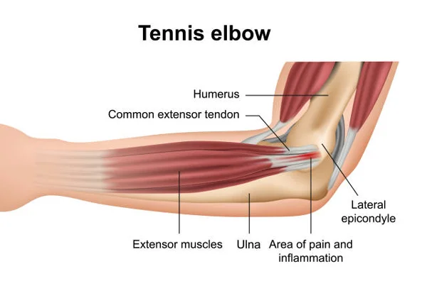 Tennis Elbow
