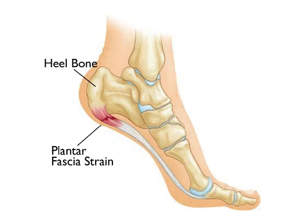Heel Pain